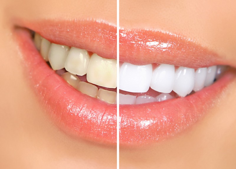 Teeth Whitening  Nyssa, OR 